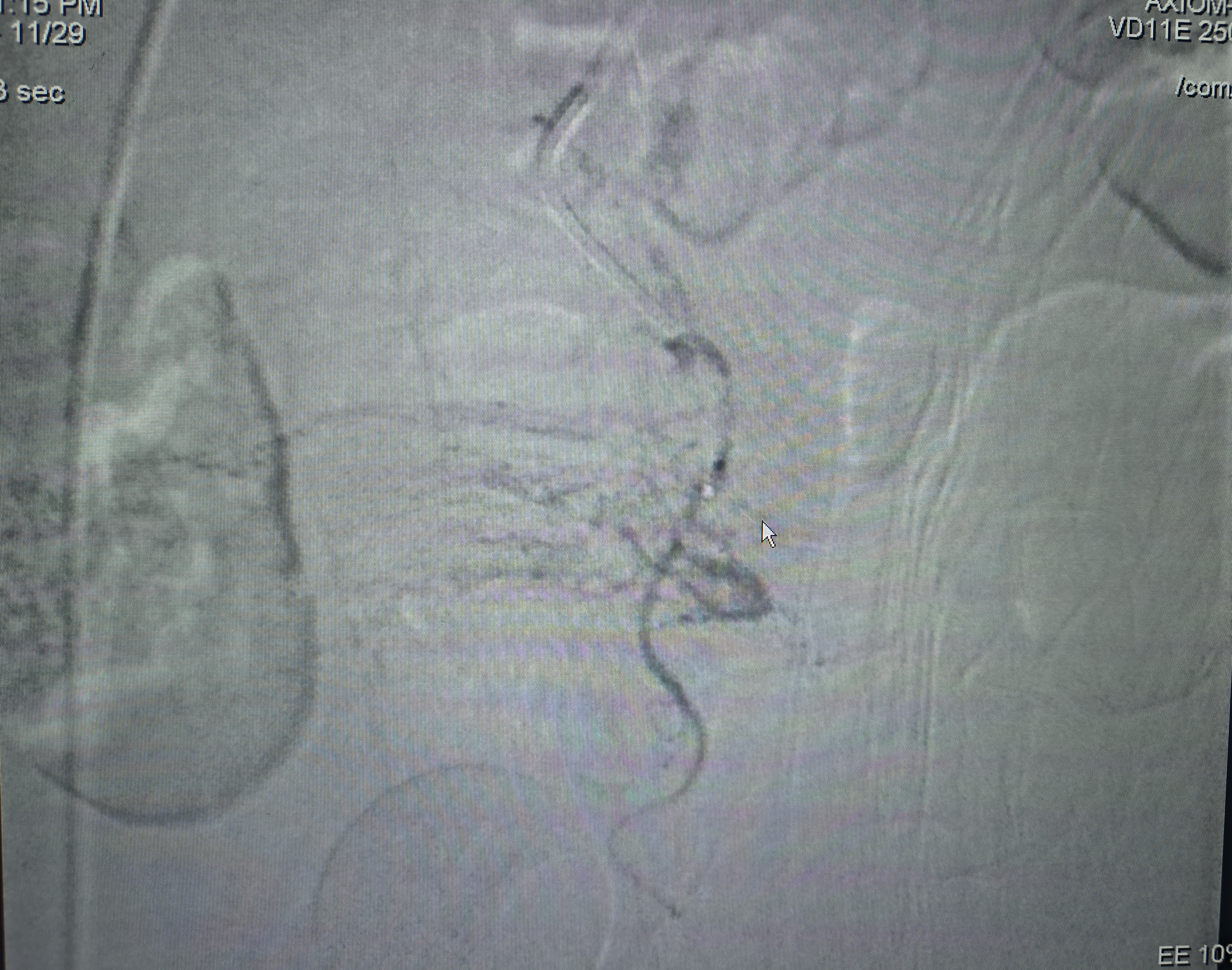 Left Superior Vesical Artery supplying the urinary bladder